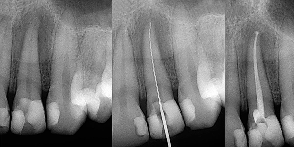 Gum Recession